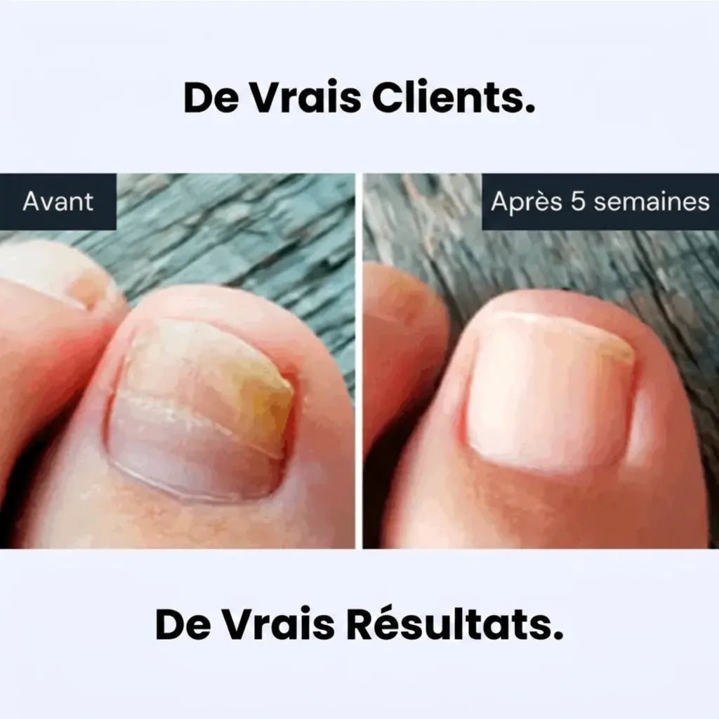 Éliminez les mycoses des ongles à la racine, et non pas seulement en surface.