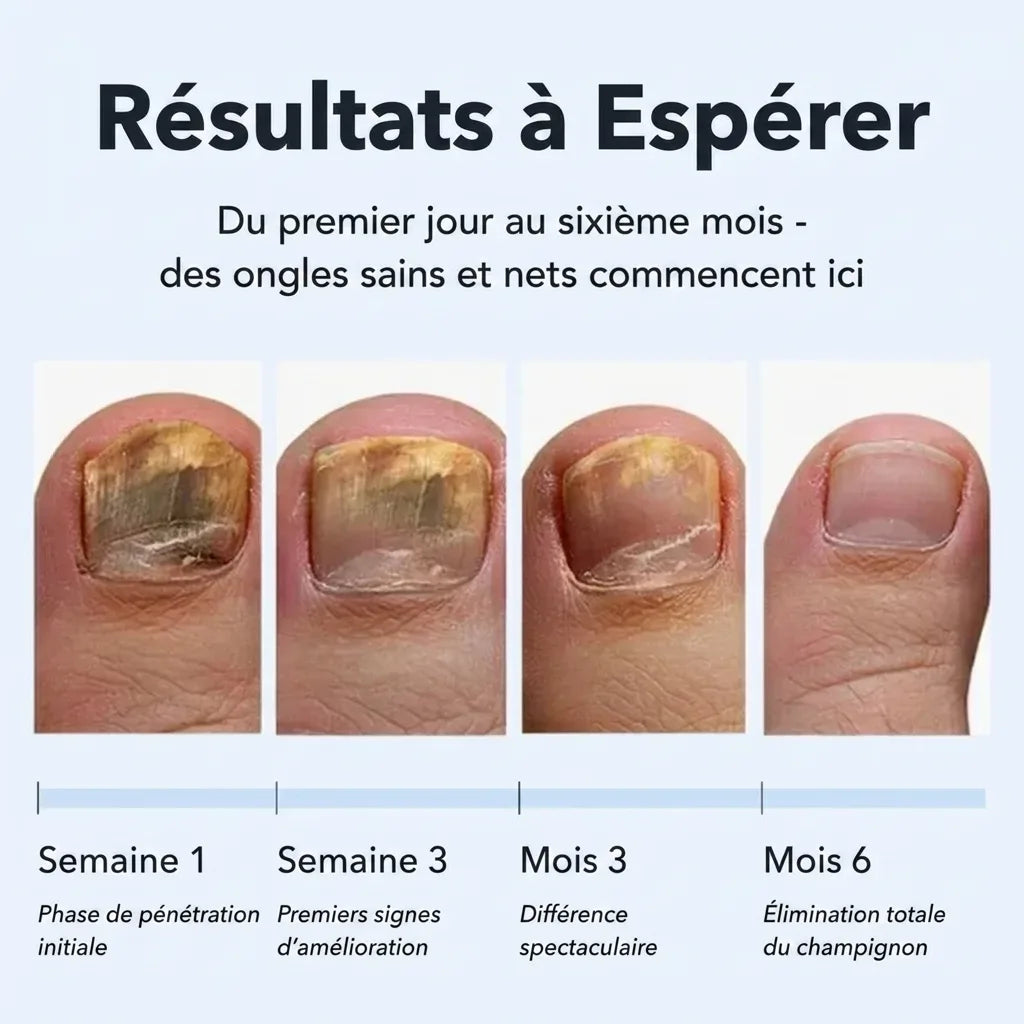 Éliminez les mycoses des ongles à la racine, et non pas seulement en surface.