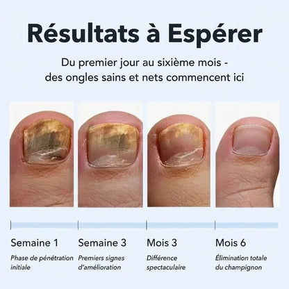 Éliminez les mycoses des ongles à la racine, et non pas seulement en surface.